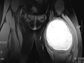 Figure 2 for case Benign Fibrous Histiocytoma